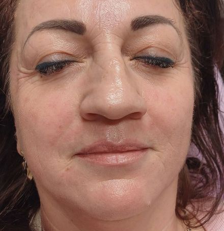 Arcfiatalítás eredmény Debrecen - természetes hatás