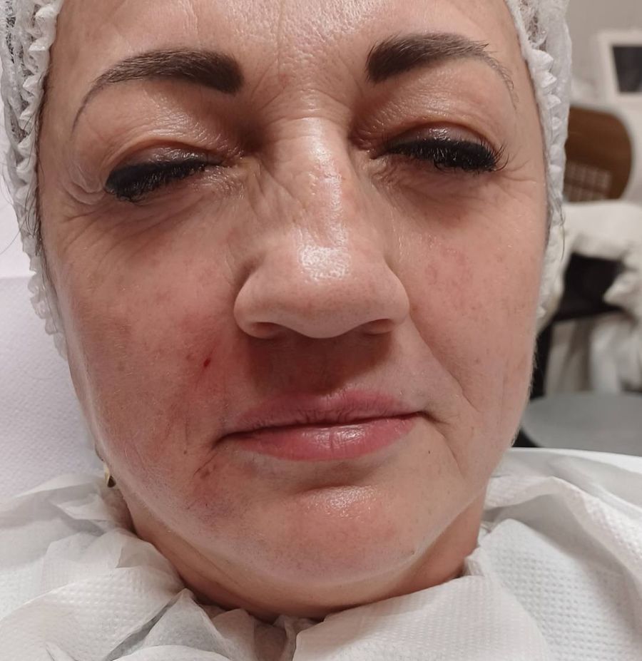 Természetes arcfiatalítás eredménye Debrecenben, harmonikus és kipihent megjelenés