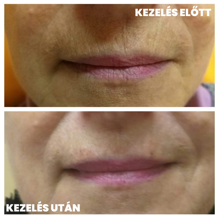 Dohányránc kezelése hyaluronsavval Debrecenben, ajak körüli ráncok csökkentése