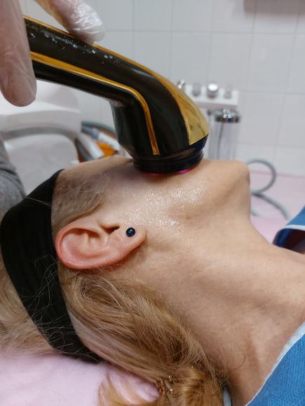 HIFU arckezelés közben - mélyrétegi, SMAS hatás HIFU kezelés során alkalmazott kezelőfej közelről