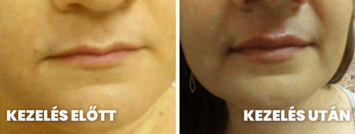 szájfeltöltés hyaluronsavval debreceni kozmetikánkban