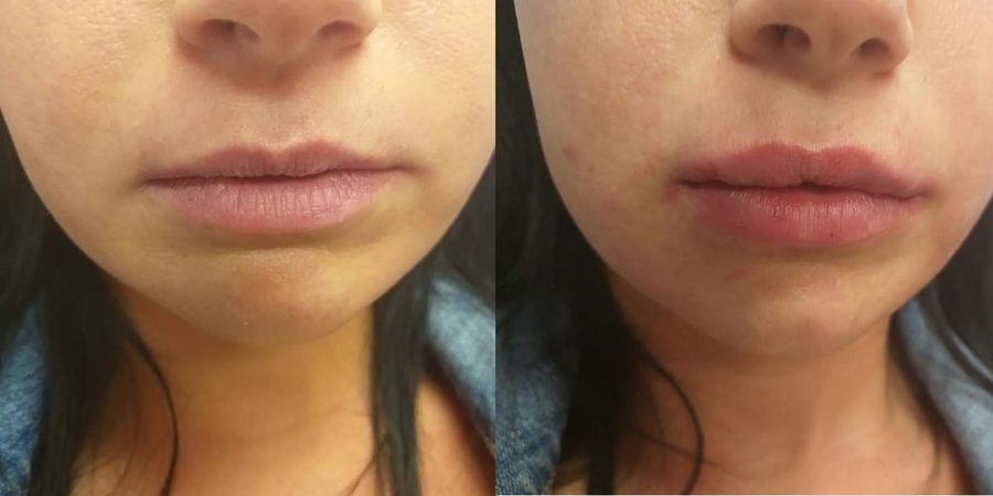 Hyaluronsavas ajakfeltöltés Debrecenben, természetes ajakforma és hidratált megjelenés