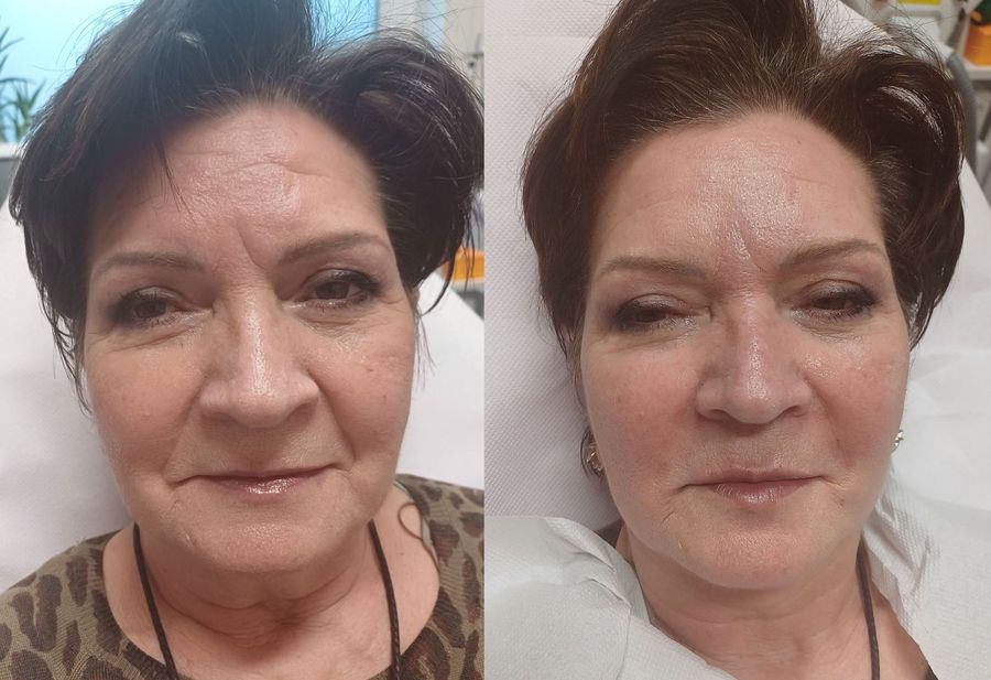 Komplex hyaluronsavas arcfeltöltés eredménye Debrecenben, volumenpótlás és arcfiatalítás