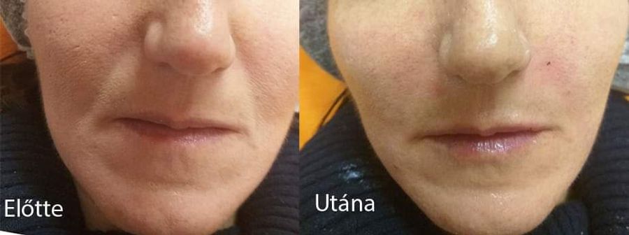 Orr-ajak barázda feltöltése hyaluronsavval Debrecenben, ráncok finomítása