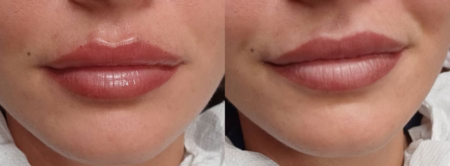 Hyaluronsavas szájfeltöltés Debrecenben, hidratáltabb és teltebb ajkak