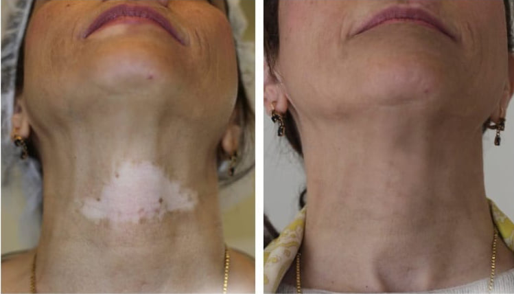 vitiligo eltüntetése orvosi pigmentációs kezeléssel