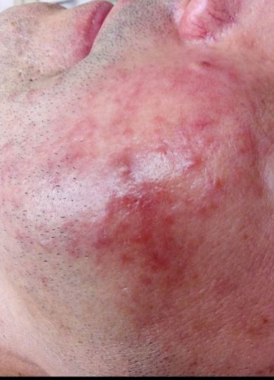 pattanasos-bor-kezeles-elott-02