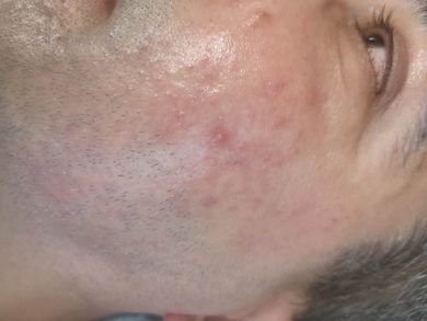 pattanasos-bor-kezeles-utan-03