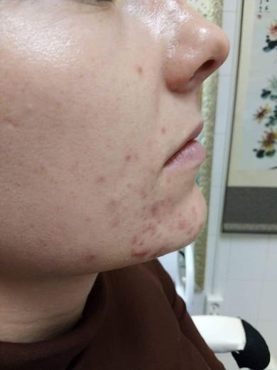 pattanasos-bor-komplex-lezeres-kezelese-03