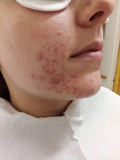 pattanasos-bor-komplex-lezeres-kezelese-04