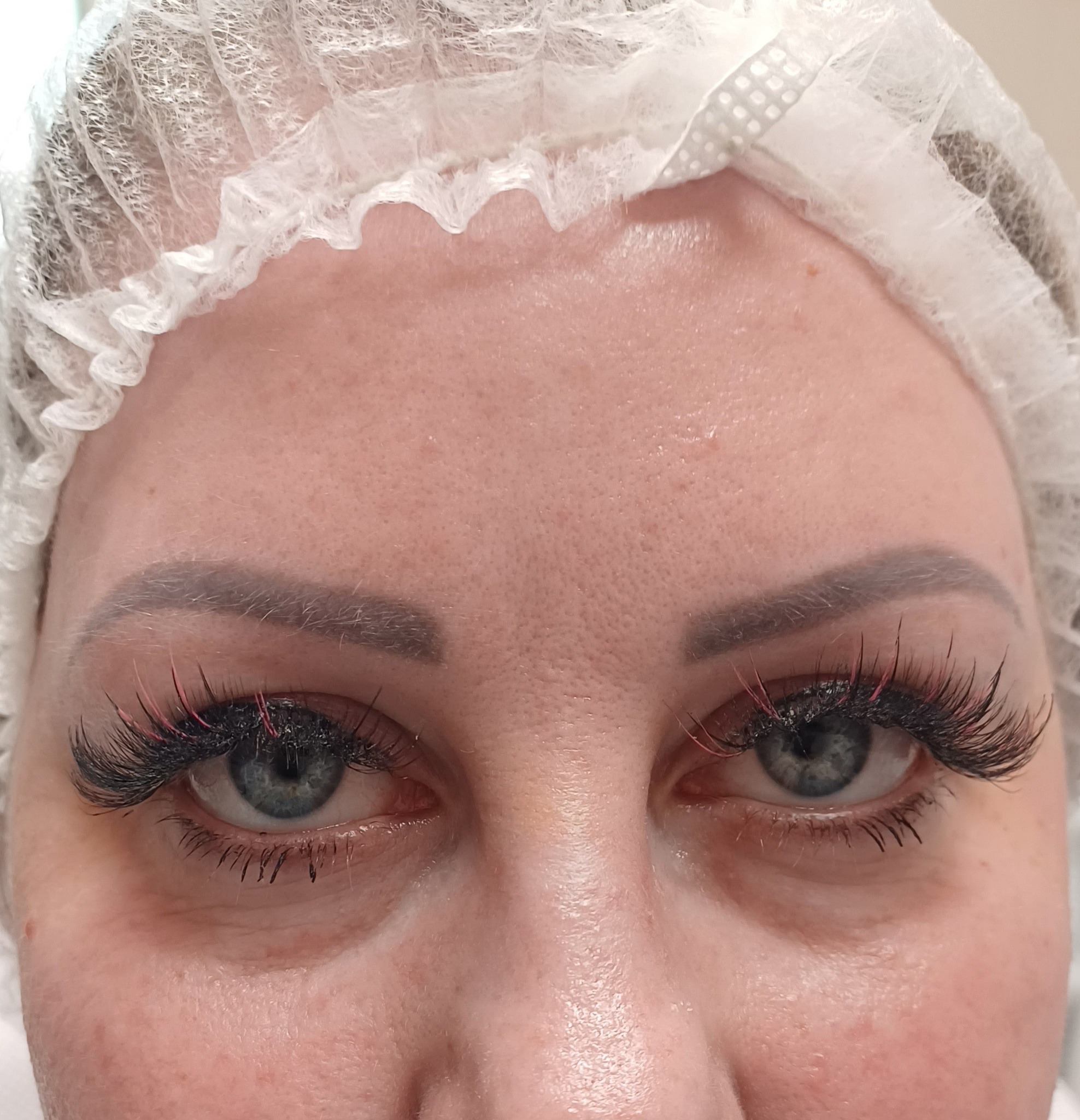 szem alatti töltés